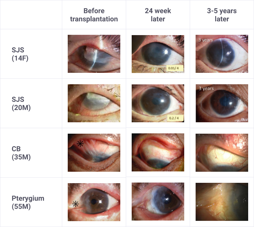 Case of COMET using amnion membrane matrix