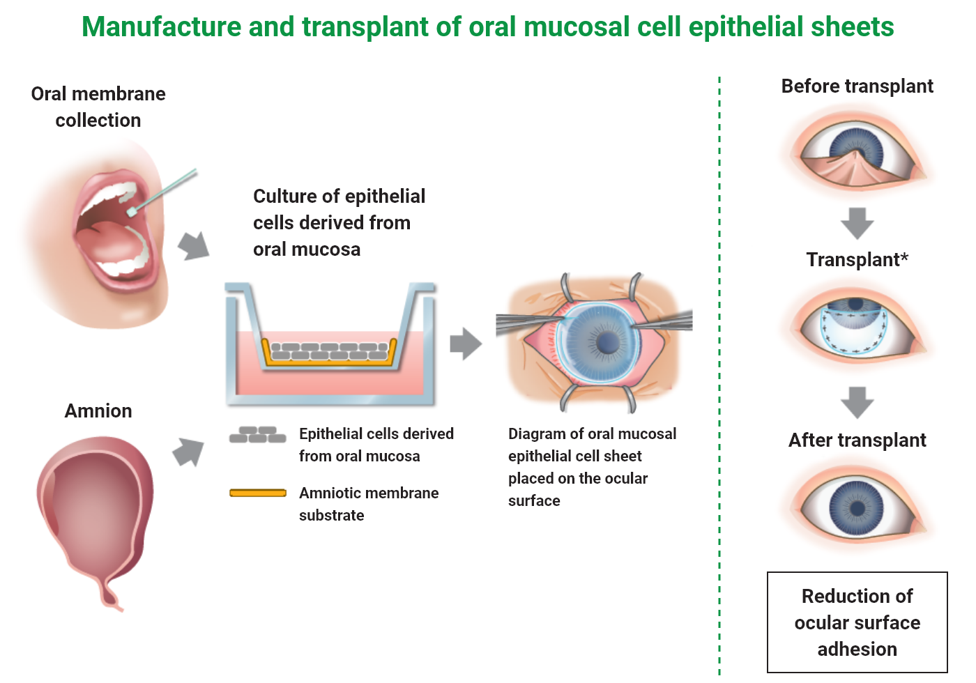 口腔粘膜上皮細胞シートの製造と移植