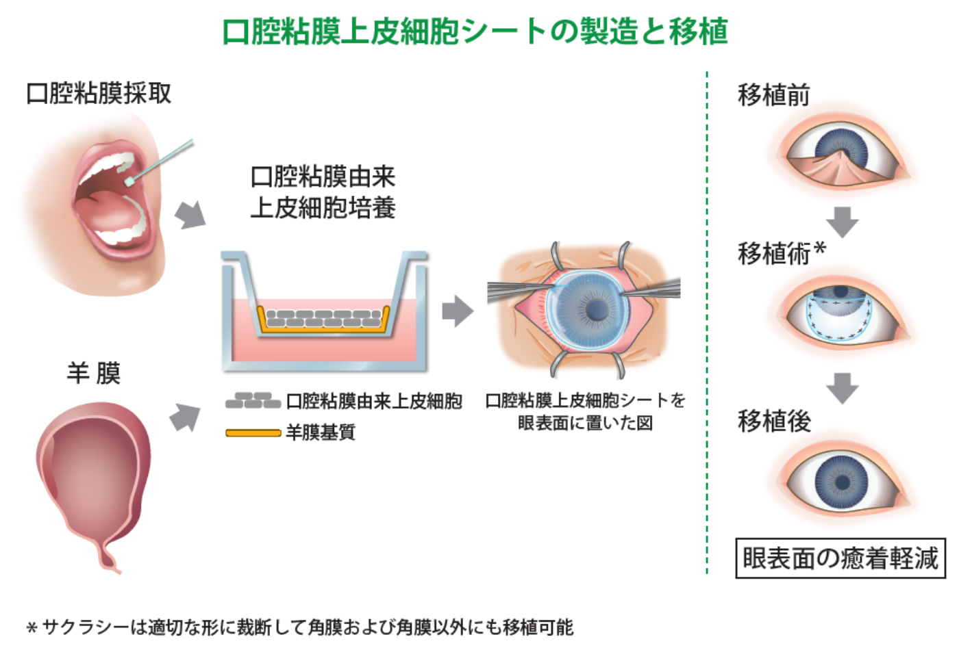 口腔粘膜上皮細胞シートの製造と移植