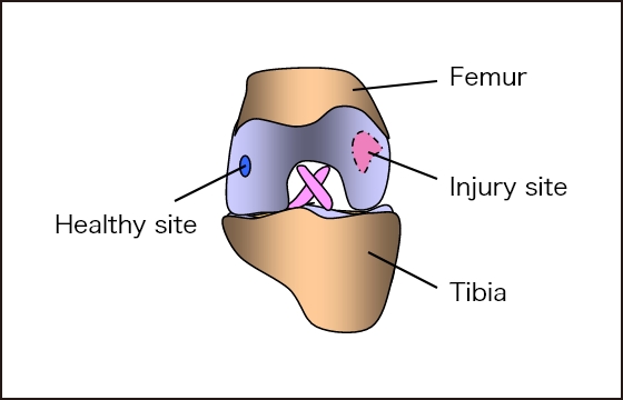 Autologous chondrocytes are collected from healthy areas
