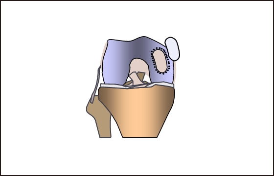 Using the same instrumentfor the damaged area Hollow out to the same size