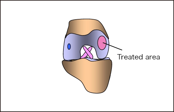 The processed IK-01 is transplanted into the damaged area. Implanted and fixed with fibrin glue (no suturing required)