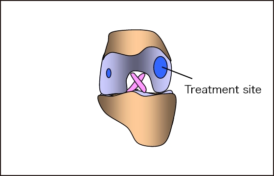 Contains type Ⅱ collagen Regenerates normal hyaline cartilage