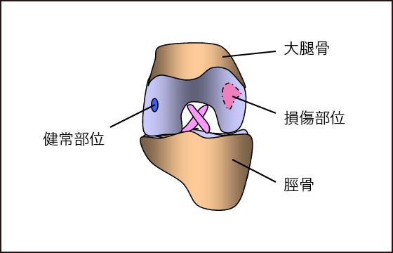 健常部位から自己軟骨細胞を採取