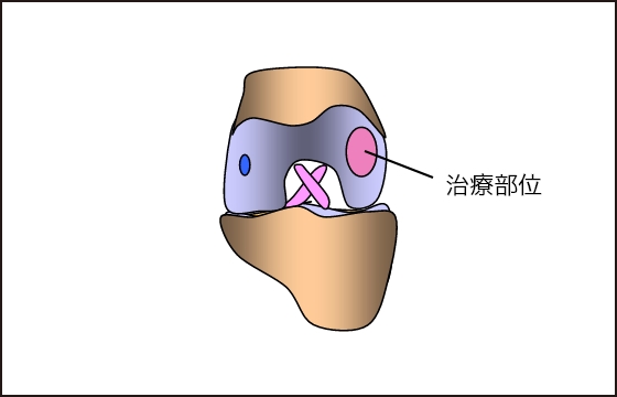 整えた損傷部位に加工したIK-01を移植し、フィブリン糊で固定（縫合不要）