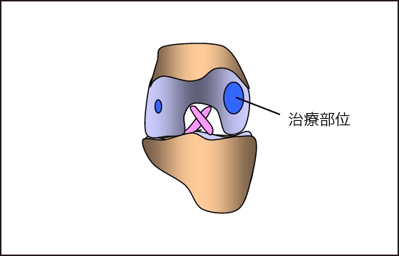 Ⅱ型コラーゲンを含む正常な硝子軟骨を再生