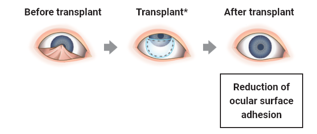 Sakracy can be cut into an appropriate shape to be transplanted into the cornea and other sites.