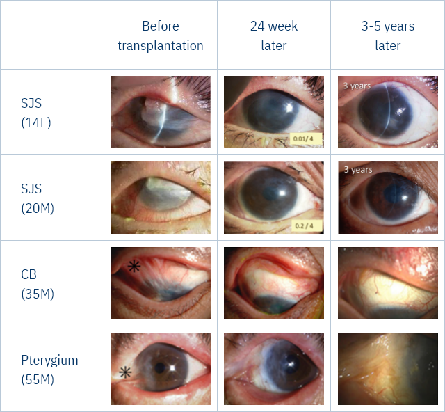Case of COMET using amnion membrane matrix