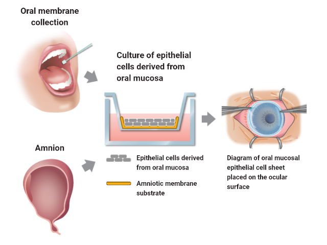 Manufacture and transplant of oral mucosal cell epithelial sheets